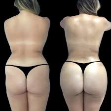 Butt Fat Transfer in Dubai