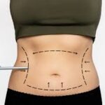 Liposuction Dubai: Recovery Timeline and Post-Treatment Care