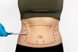 Liposuction Dubai: Recovery Timeline and Post-Treatment Care