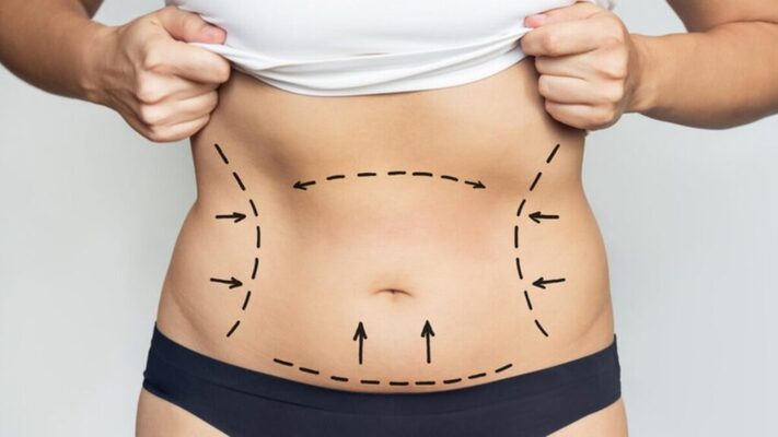 liposuction in dubai