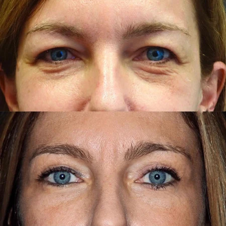 Blepharoplasty in Dubai