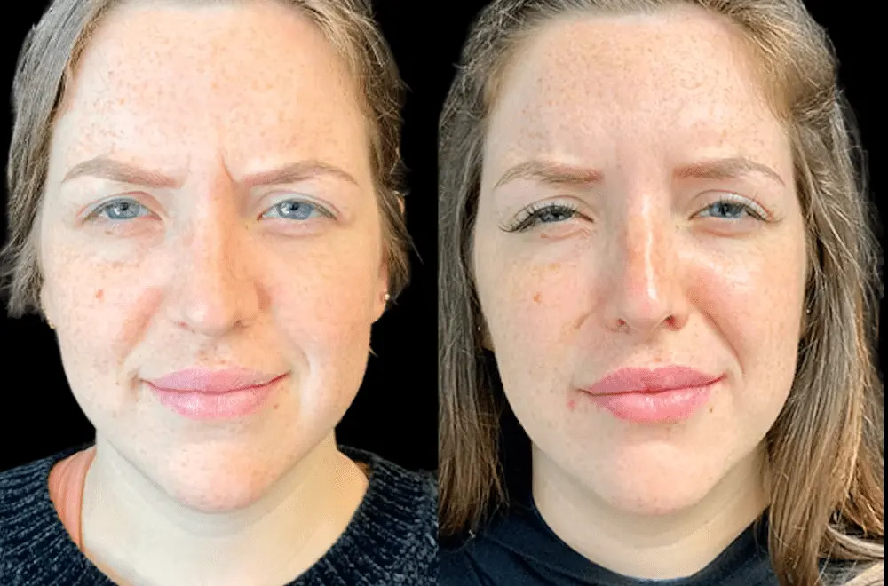 Best Doctors in Dubai Explain Why Celebrities Choose Botox