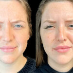 Preventive Anti-Aging Solutions with Botox in Dubai