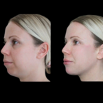 Jawline Fillers in Dubai