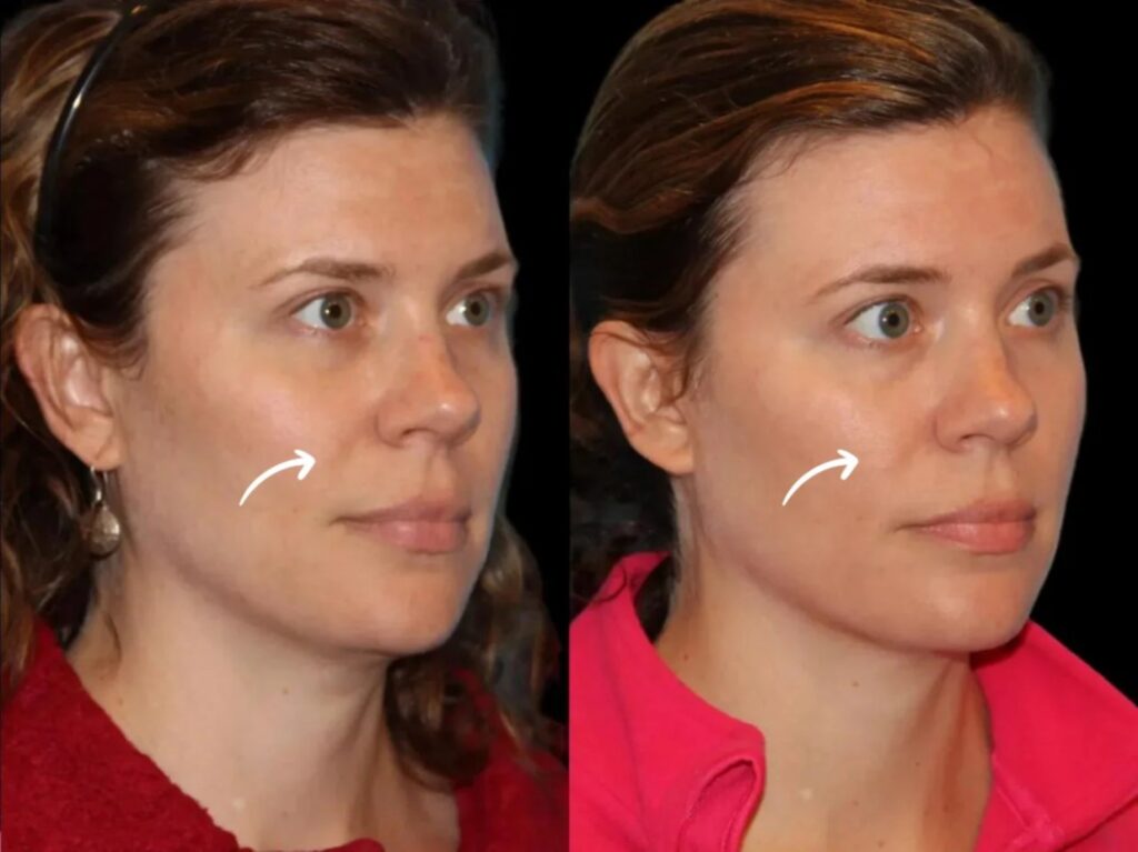 sculptra in ubai
