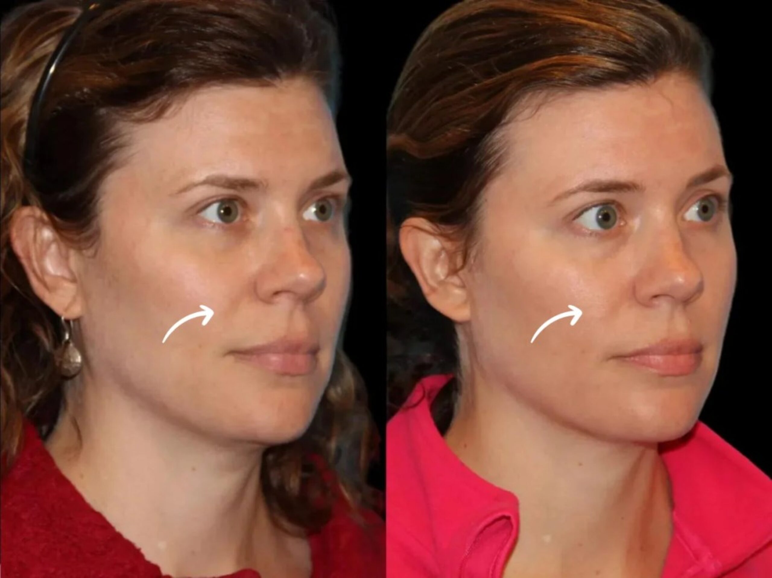 sculptra in ubai