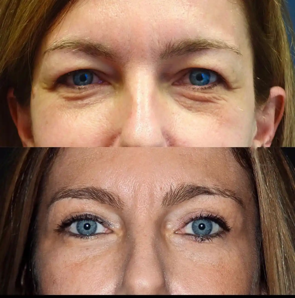 Eye Bag Removal in Dubai