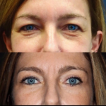 Eye Bag Removal in Dubai