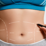 abdominoplasty in jeddah
