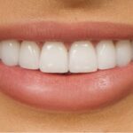 Tooth Crown Dubai: When and Why You Need a Crown