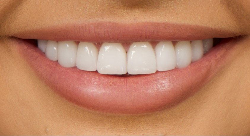 Tooth Crown Dubai: When and Why You Need a Crown
