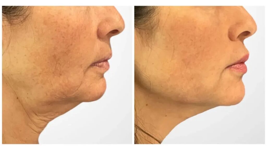 Innovative Facial Lifting Thread Lift Treatment in Dubai