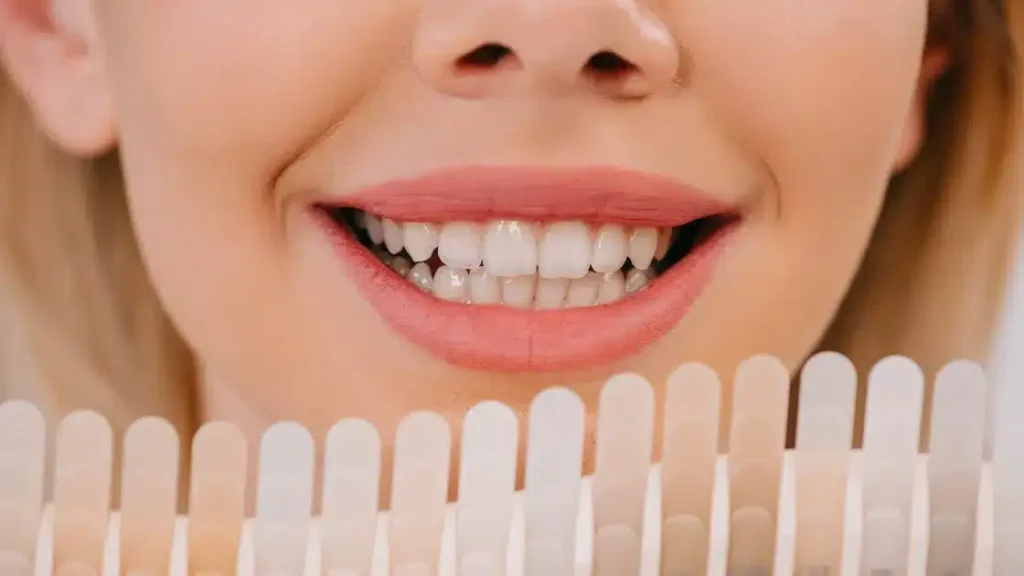 Veneers Dubai
