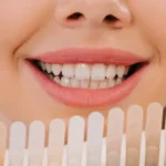 Veneers Dubai