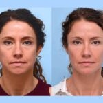 Thread Lift with Best Plastic Surgeons in Dubai Refined Youthful Contours