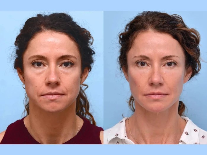 Boost Facial Firmness Long-Term Through Collagen-Enhancing Thread lift Treatments in Dubai
