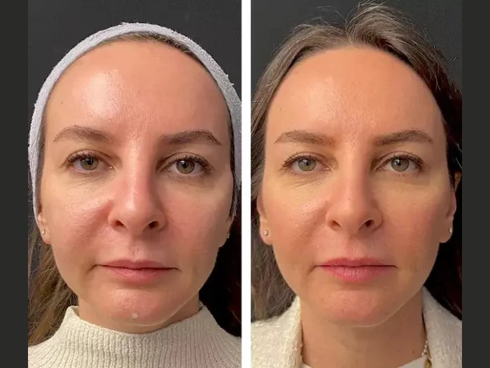 Mesotherapy Treatment in Dubai: Latest Trends in Aesthetic Medicine