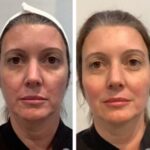 Thread lift in Dubai Tailored to Individual Facial Anatomy Needs
