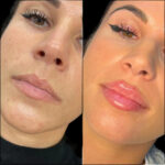 Dermal Fillers