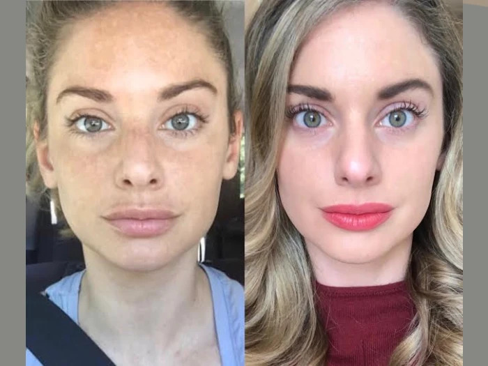 Radiofrequency (RF) Microneedling for Comprehensive Skin Care by the Best Aesthetic Clinic in Dubai