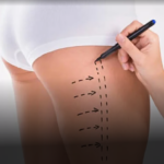 Thigh Liposuction In Dubai
