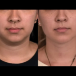 Double chin removal in Dubai
