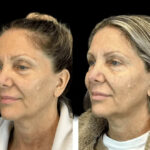 Botox in Dubai