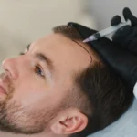 Hair Transplant In Dubai: Permanent Hair Restoration