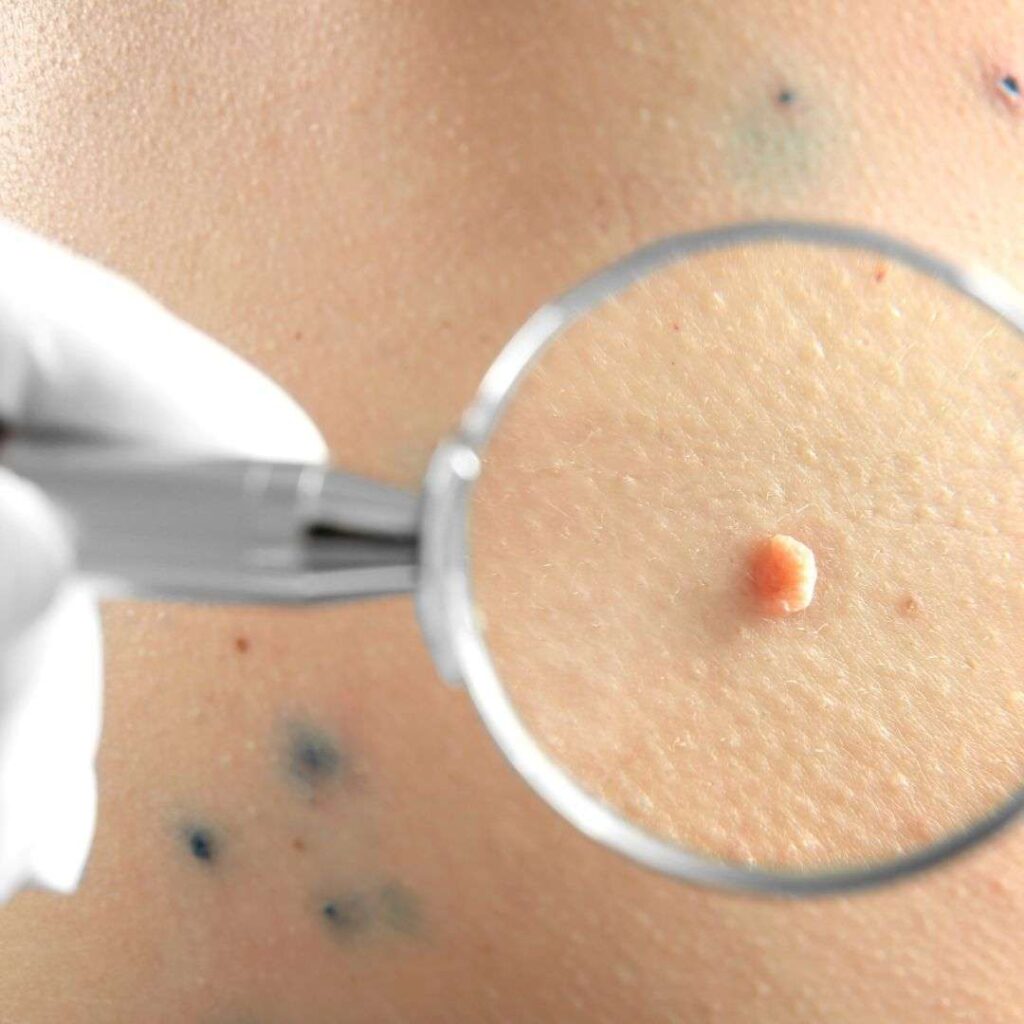 Moles Removal in Dubai