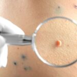 Moles Removal in Dubai