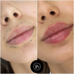 Juvederm in Dubai