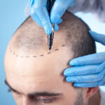 Modern Hair Restoration with Hair Transplant in Dubai