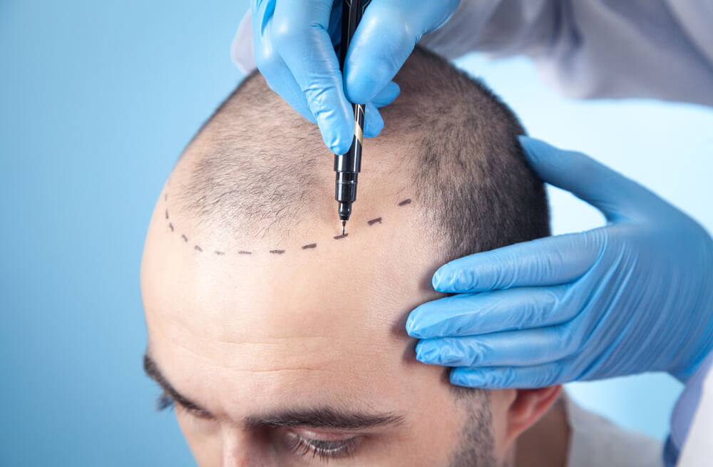 Modern Hair Restoration with Hair Transplant in Dubai