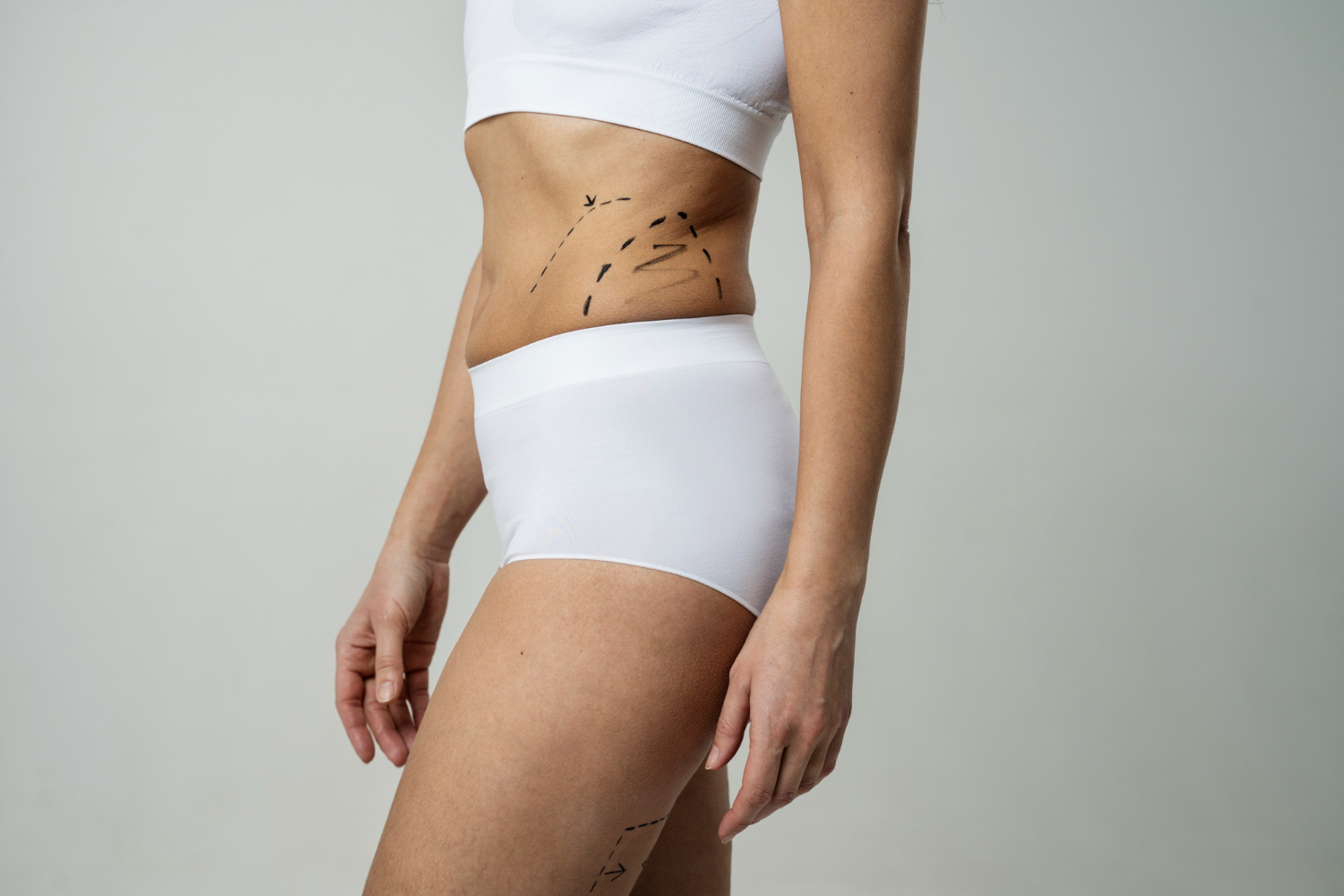 Liposuction in Dubai