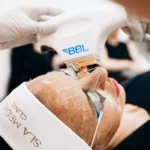Bbl Laser In Manchester