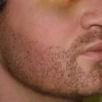 Beard Transplant in Dubai: Achieve a Fuller Look