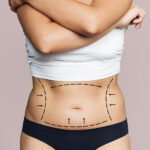 Everything About Liposuction Dubai for Body Contouring