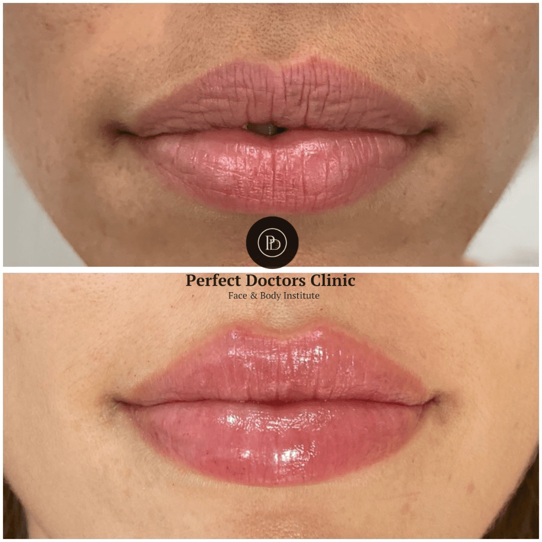 Juvederm in Dubai