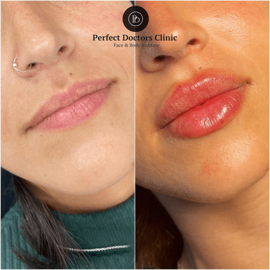 Juvederm in Dubai