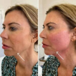 How Endolift Treatments in Dubai Help Restore Facial Definition