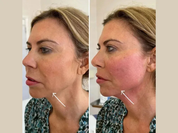 How Endolift Treatments in Dubai Help Restore Facial Definition