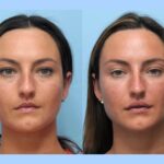 Best Plastic Surgeon in Dubai Specializing Advanced Techniques For Facial Thread Lift