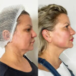 Best Plastic Surgeon in dubai Delivering Endolift Tightening With Precision