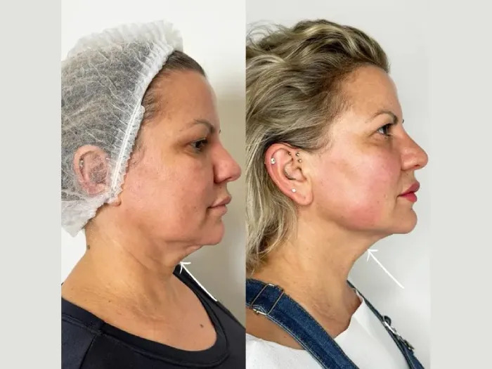 Best Plastic Surgeon in dubai Delivering Endolift Tightening With Precision