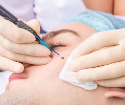 Skin Tags Removal in Dubai: Safe and Effective Skin Refinement