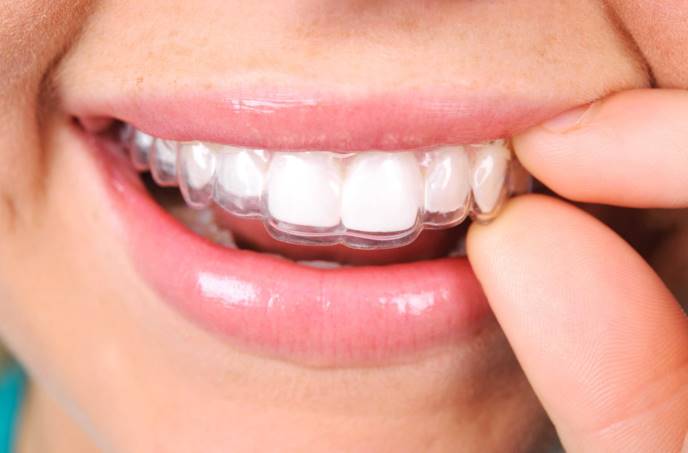 Common Questions About Invisalign Dubai Answered