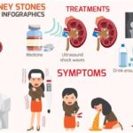 9 Signs Your Kidney Stone May Need Surgery Instead of Medication 