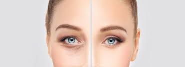 Chirurgie des paupières inférieures à Paris
