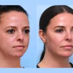 Best Plastic Surgeons in Dubai: Premium Facial Tightening Thread Lift Treatments