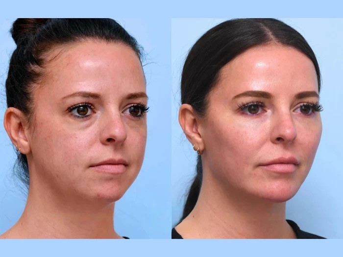 Best Plastic Surgeons in Dubai: Premium Facial Tightening Thread Lift Treatments